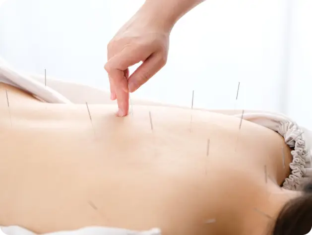 Acupuncture for Back Pain change