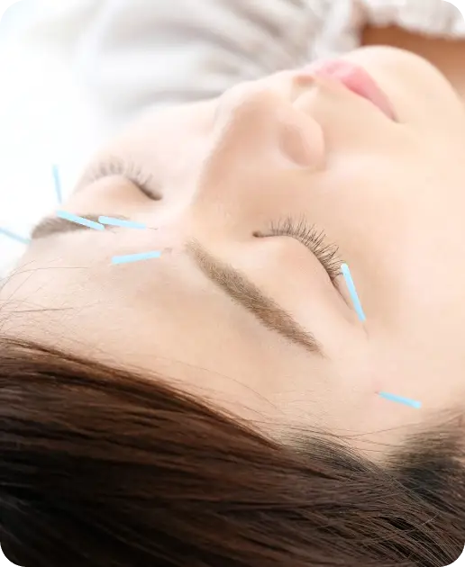 Acupuncture for Migraines